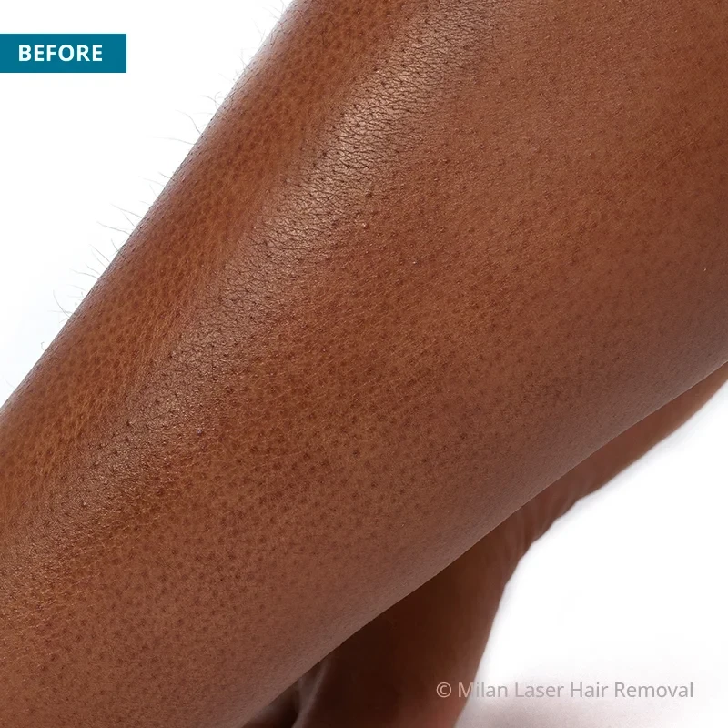 Legs and Feet Before & After Photos of Laser Hair Removal Milan Laser